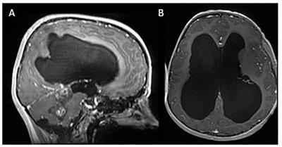 Case report: Pediatric low-grade gliomas: a fine balance between treatment options, timing of therapy, symptom management and quality of life